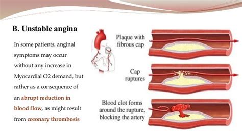 Angina Pectoris