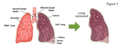 Pneumonectomy | Mary Washington Healthcare