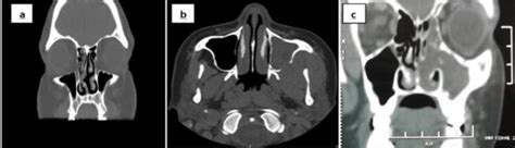 Ct Scan Pns Showing A Dns B Maxillary Sinusitis C Antrochoanal