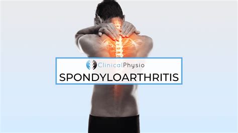 Axial And Peripheral Spondyloarthritis Clinical Physio Membership