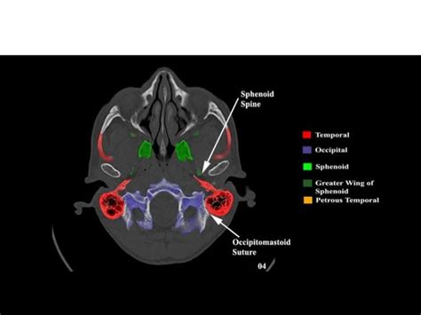 Greater And Lesser Wing Of Sphenoid Ct - slidesharetrick