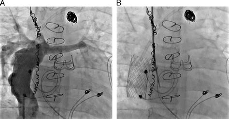 Trans Fontan Baffle Placement Of An Endocardial Systemic Ventricular