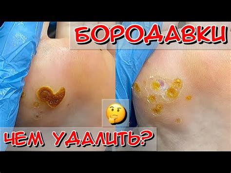Чем удалять бородавки? / бородавки на стопе / заключительный визит ...