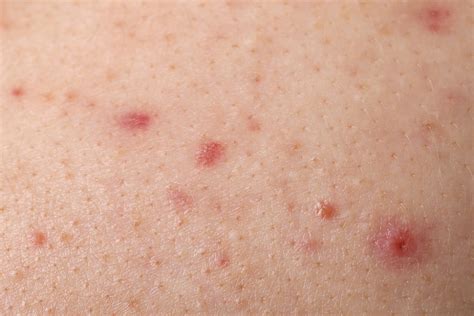 Butt Acne What It Is Causes And Treatment Options Available