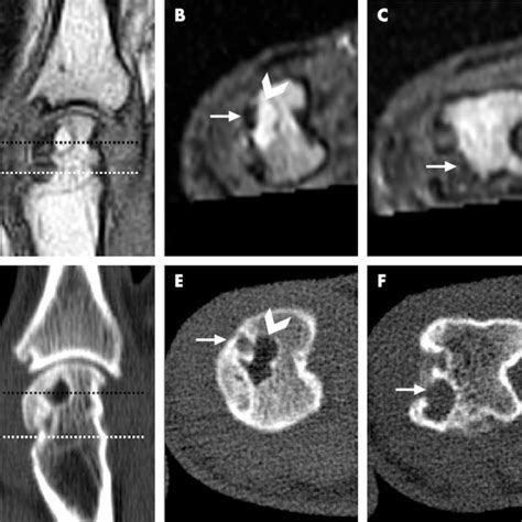 The Second Mcp Joint Of A Patient With Ra On A C T1 Weighted Mri And Download Scientific