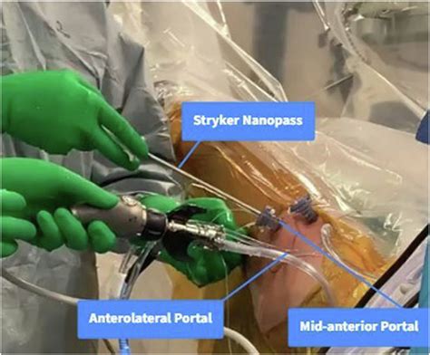 Intraoperative Image Of A Left Acetabular Labral Repair Displaying The