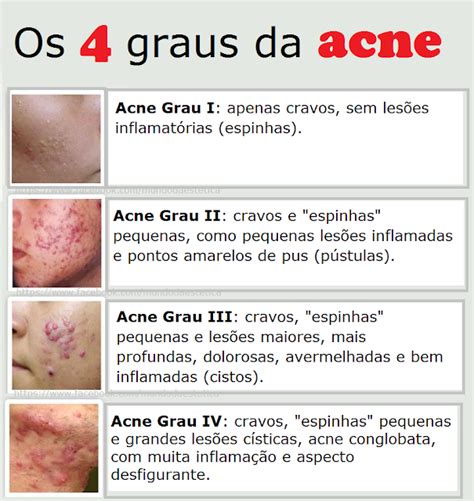 Pele Acneica ACNE E SEUS GRAUS