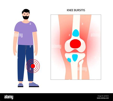 Bursitis prepatellar fotografías e imágenes de alta resolución Alamy