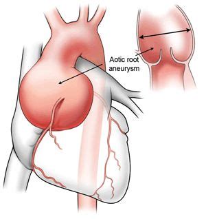 Surgeon Q A Are Aortic Aneurysms Valve Disease Common Heart