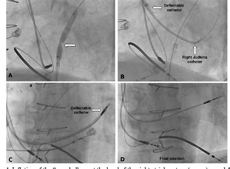 Figure From Left Ventricular Endocardial Pacing Techniques As An