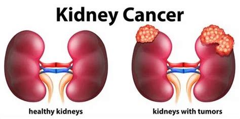 Allopathic Kidney Cancer Treatment Services, North Bangalore Hospital ...