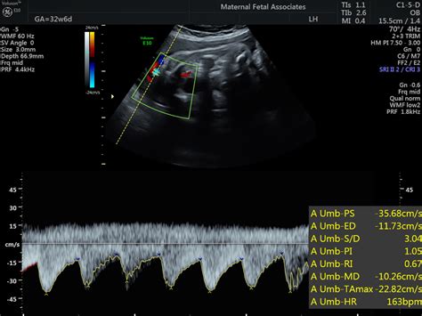 Doppler Evaluation Maternal Fetal Associates Of The Mid Atlantic