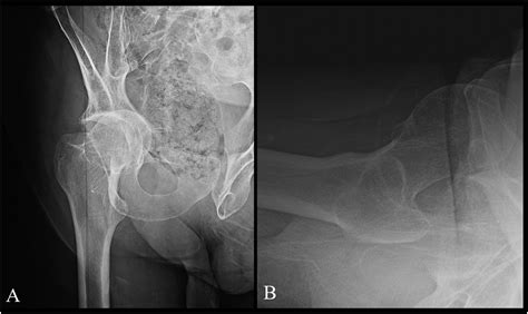 Anterior Hip Dislocation Complicated By Thrombus In The Common Femoral