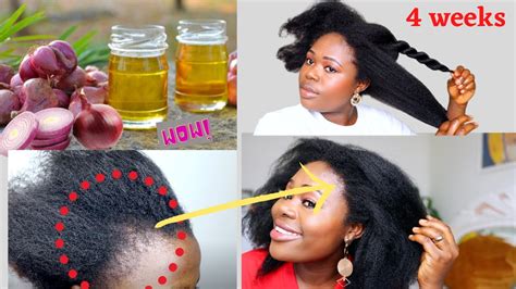 Grow Hair In 4 Weeks With Onion Oil Home Made Onion Oil For Rapid Hair