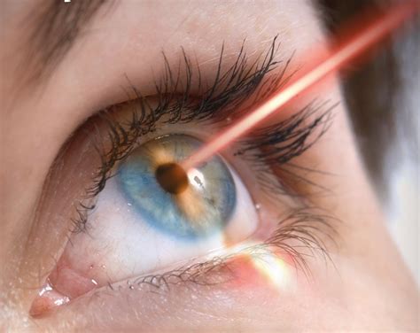 Prk Eye Surgery Laser Eye Surgery Lasik Surgery Eye Treatment Laser