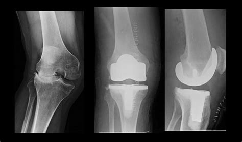 Oa With Severe Valgus Deformity 7 Changes Done To Preliminary Plan