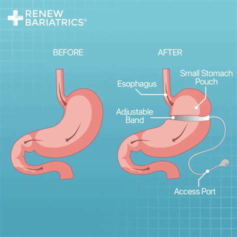 Lap Band Surgery In Mexico Gastric Band In Tijuana Mexico