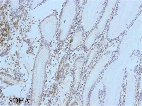 Expression Of The Oxphos Complexes And Porin In Diffuse Type Gc Case