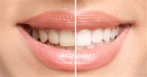 Teeth Whitening Treatment Types Pros And Cons AHS