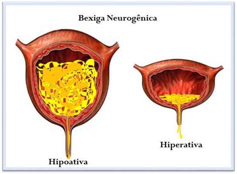 S Ndrome Da Bexiga Hiperativa Causas E Tratamento