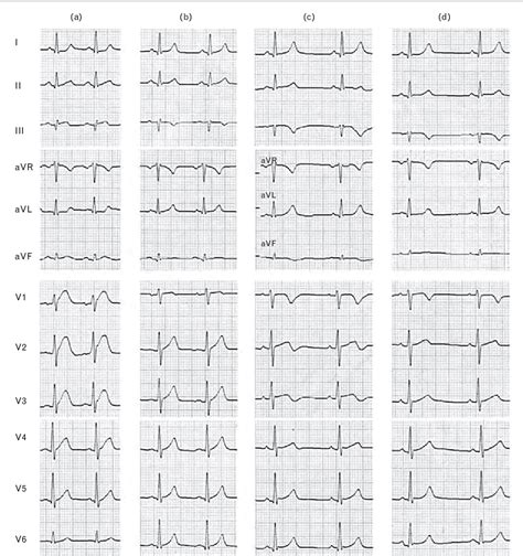 Figure 1 From Pathophysiology And ECG Patterns Of Isolated Right