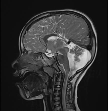 Subependymal Grey Matter Heterotopia With Partial Corpus Callosum