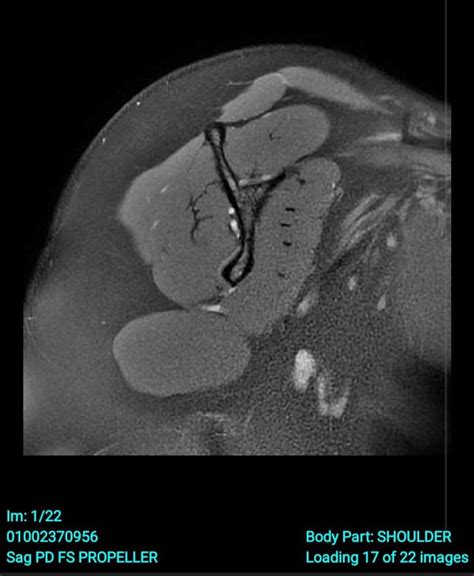 Shoulder MRI : r/medical