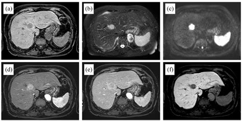 MRI findings using Gd-EOB-DTPA. The mass exhibited low intensity on ...