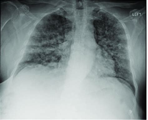 Anterior Posterior Chest X Ray Showing Extensive Bilateral Nodular