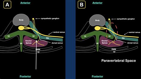 Erector Spinae Plane Block Fig2 Acep Now