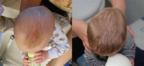 Defomrational-Plagiocephaly_BeforeandAfter - Essential Health Chiro