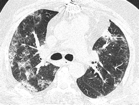 Implications Of Sex Difference In Ct Scan Findings And Outcome Of