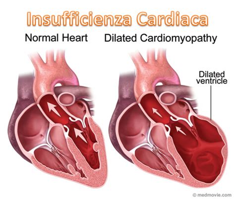 Entresto Nuovo Farmaco Nel Trattamento Della Insufficienza Cardiaca