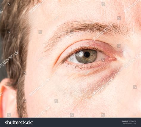 Bags Under Eyes Men Images Browse 380 Stock Photos And Vectors Free