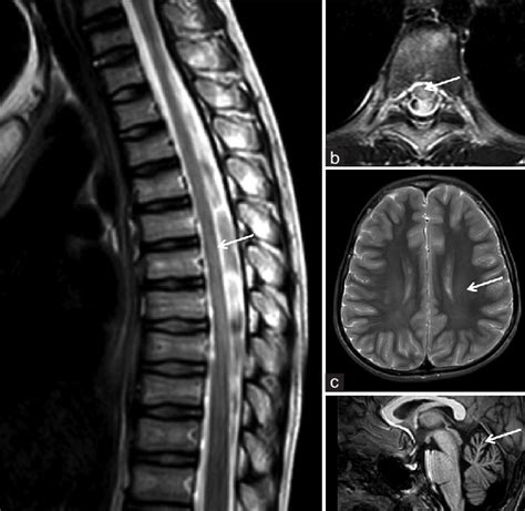 Mri Spine And Brain Reveals Diffuse Ill Defined T2 Hyperintense Signal