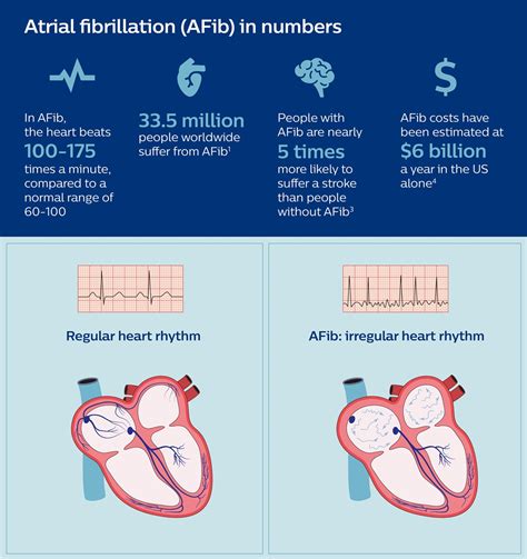 Atrial Fibrillation Heart Diagram