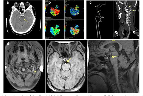 Figure From Top Of Basilar Syndrome Due To Vertebral Artery