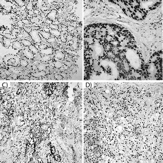 Androgen Positive Nuclei Of Prostate Carcinoma Cells A Gleason