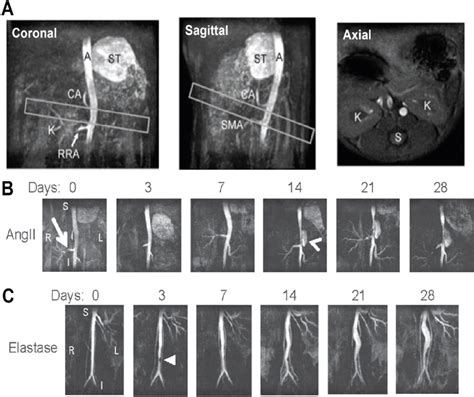 Time Of Flight Magnetic Resonance Angiography Tof Mra Of Abdominal