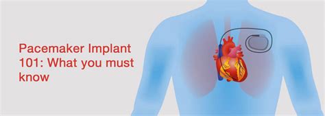 Pacemaker Implant 101: What you must know