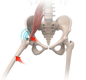 Iliopsoas Impingement Treatment Naples FL Hip Joint Injury Fort Myers