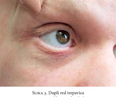 Figure 3 From LYMPHEDEMA DISTICHIASIS SYNDROME A CASE REPORT