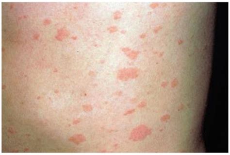 Erythematous Maculopapular Rash Without Distinct Margins Caused By Download Scientific Diagram