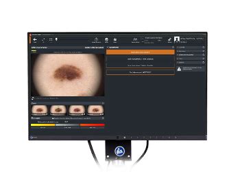 Künstliche Intelligenz in der Dermatologie FotoFinder Systems