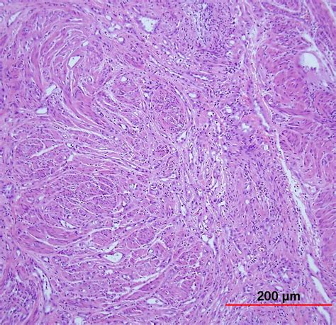 Pathology Outlines Adenomatoid Tumor