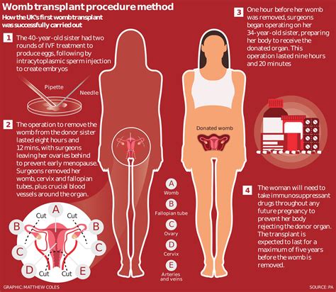 Surgeons Perform Uks First Womb Transplant Giving Women Without A Uterus Hope Of Giving Birth