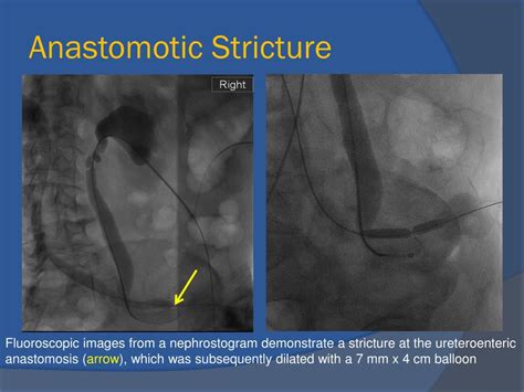 Ppt Multi Modality Imaging Of Urinary Diversion Complications