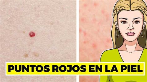 Las 11 causas más comunes de los puntos rojos en la piel