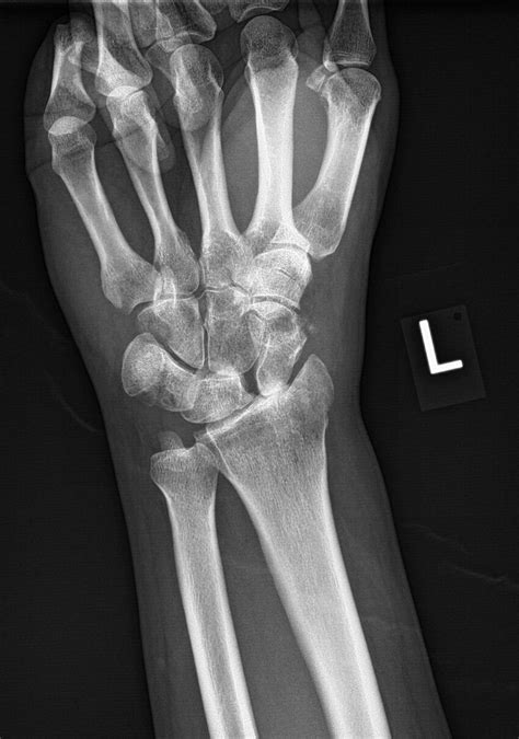 Radiopaedia Case Fracture Of The Radial Styloid Process With