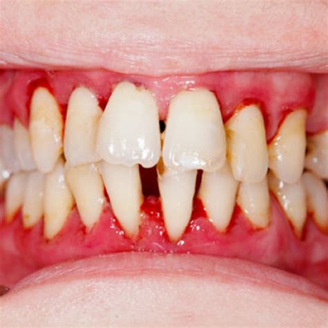 Understanding Gum Disease Causes Symptoms And Effective Treatments